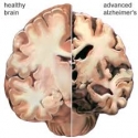 Alzheimer brein